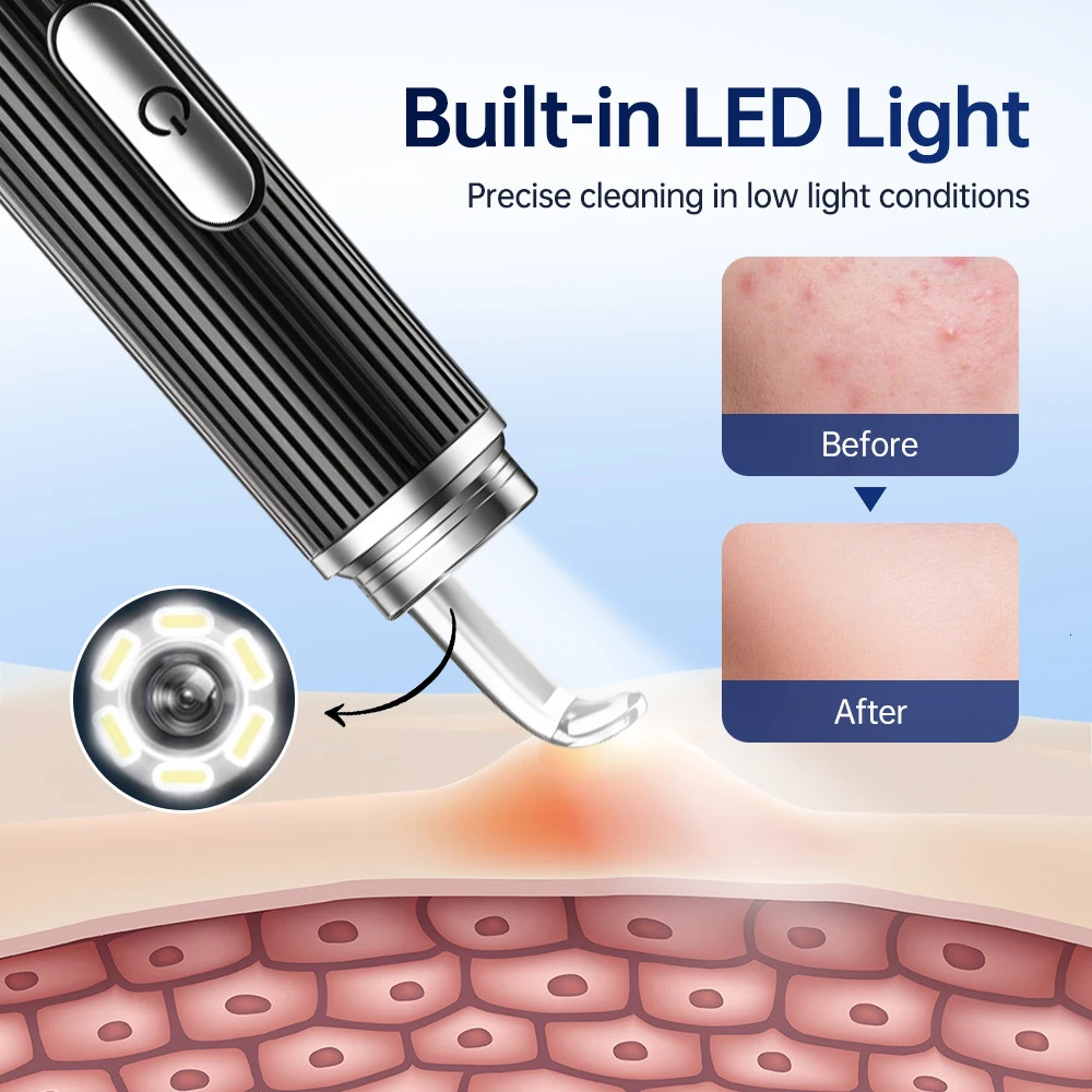 Visual Blackhead r with Camera Pimple Popper Extractor Tool Pore Cleaner Kit for Comedone Whitehead Black Dots 250726