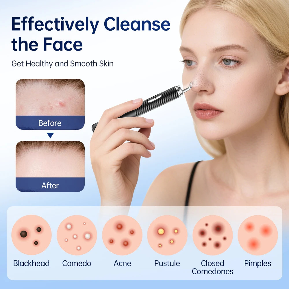 Visual Blackhead r with Camera Pimple Popper Extractor Tool Pore Cleaner Kit for Comedone Whitehead Black Dots 250726