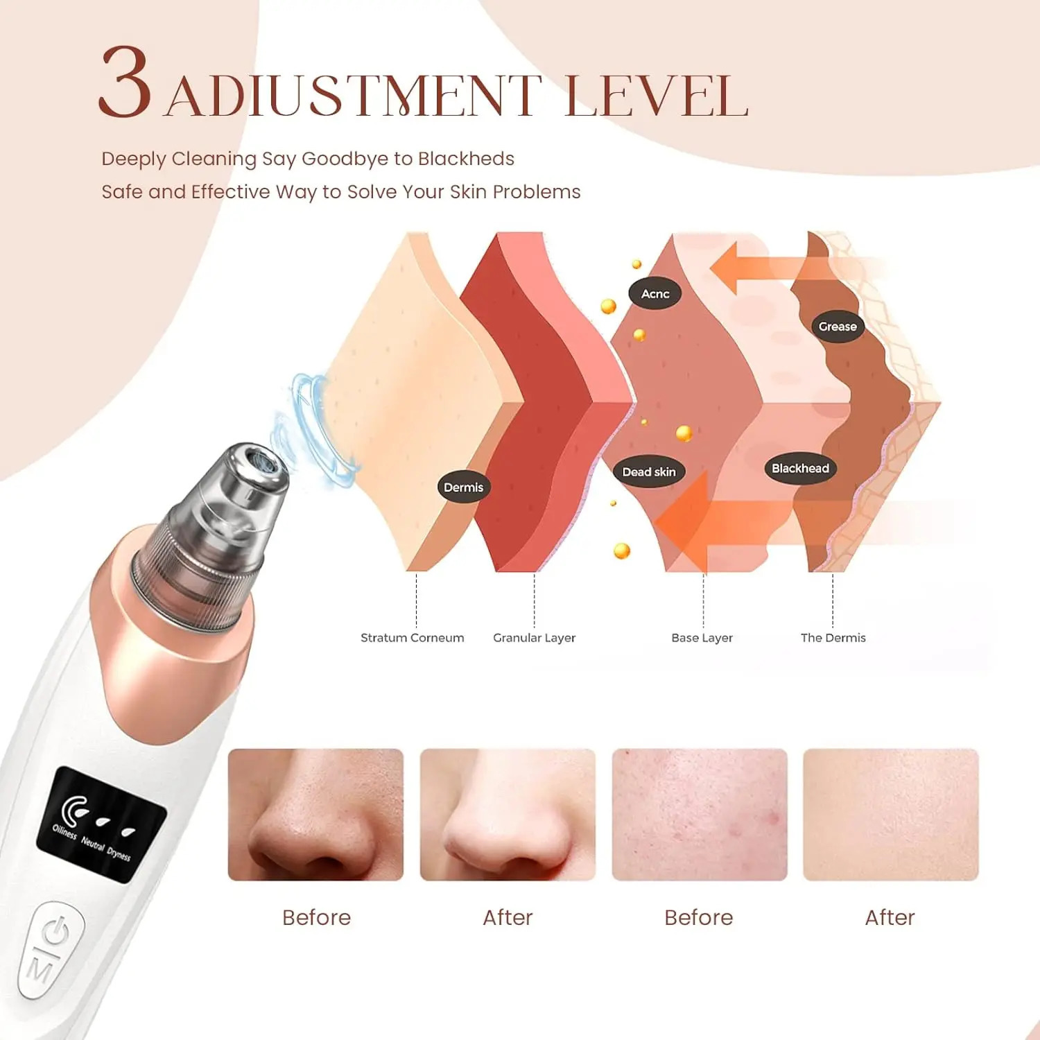 est Technology Blackhead r Vacuum Pore Cleaner for FaceNose Blackhead Removal Kit Electric Facial Extractor Tool 251030