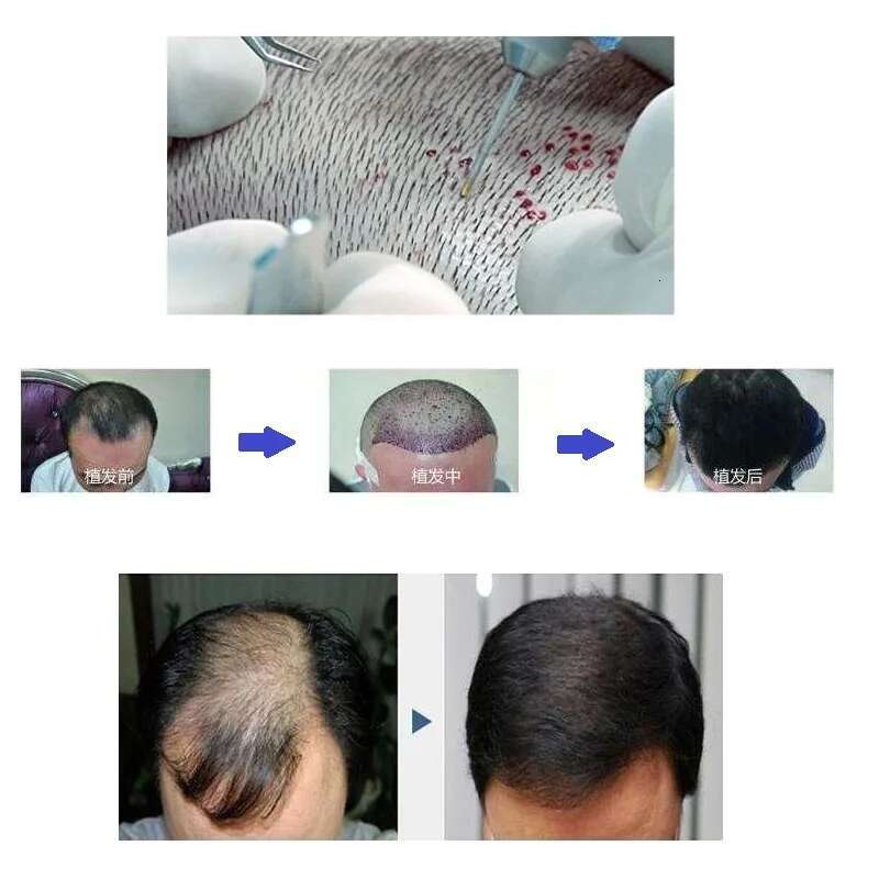 Fue Transplant Follicle Extractor Scarless For Thinning And Balding Treatment Implanted Hair Eyebrow Makeup Tools