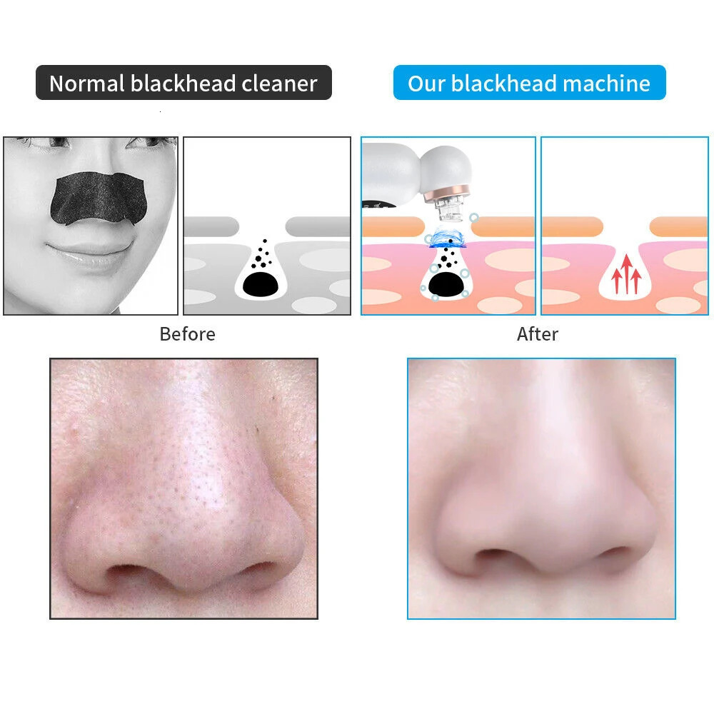 Blackhead r Vacuum Suction Personal Care Small Bubble Electric Face Nose Cleaner 251030