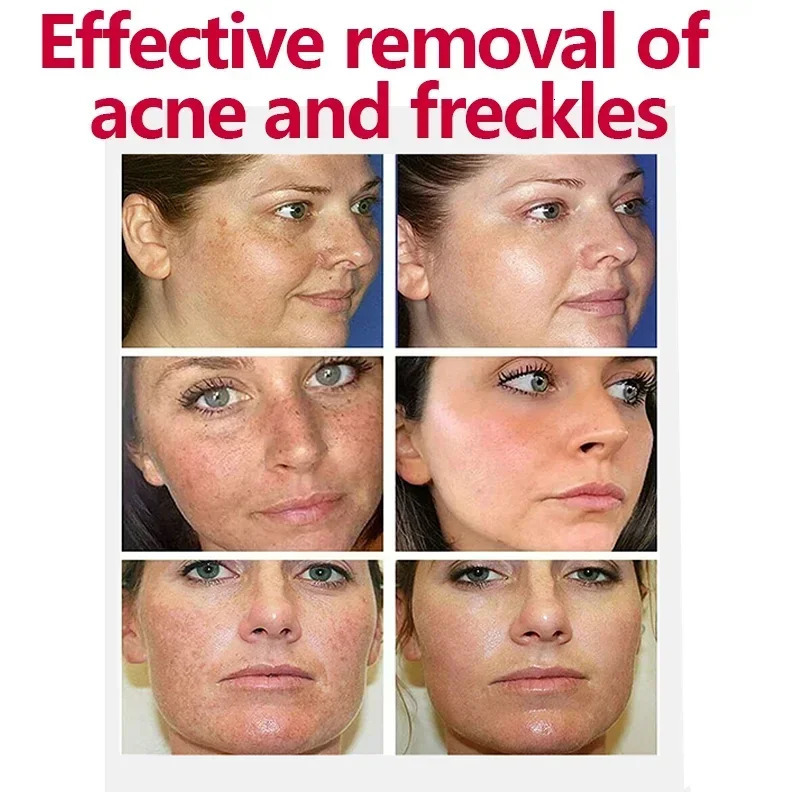 Freckle Cream Effectively reduces Brightens and revitalizes dull skin Hydrates and nourishes the skin 251030