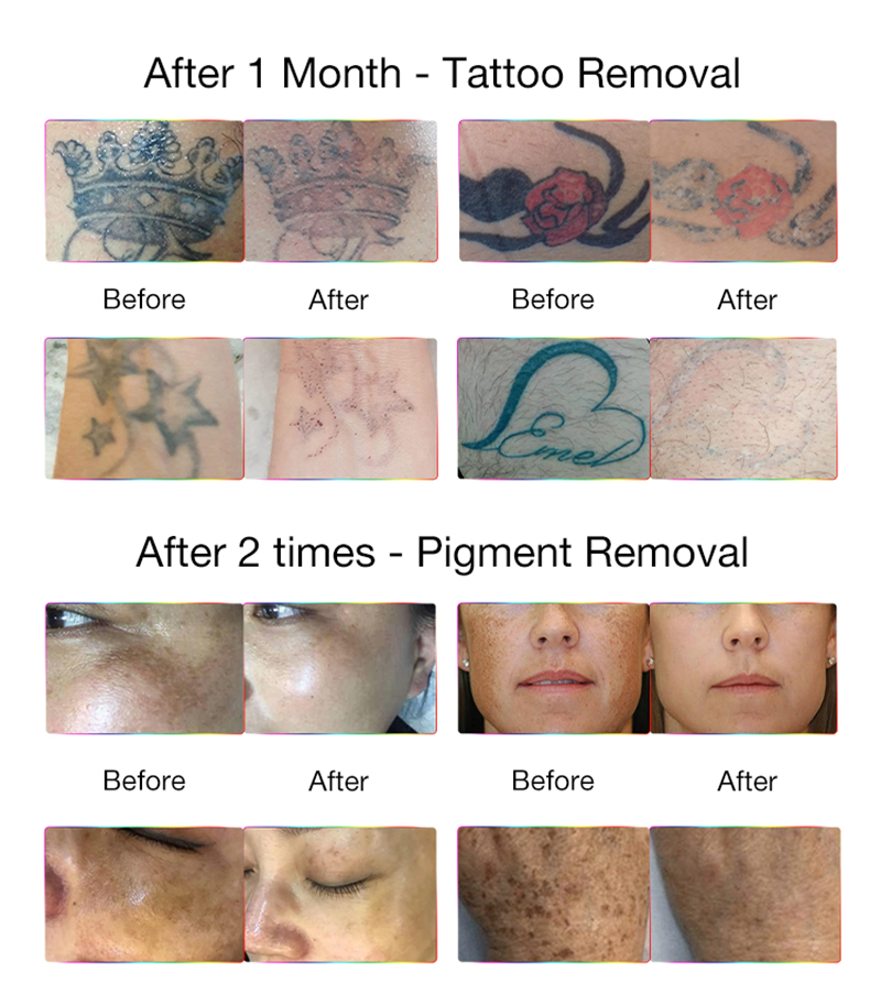 Picosecond Laser Tattoo Removal Machine Melasma removal 1064nm 532nm 755nm Skin Rejuvenation Nd Yag Beauty Salon Equipment
