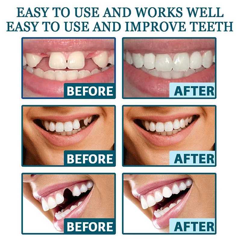 New Arrival Adjustable braces perfectly fit teeth whitening buckles silicone portable braces decorative gaps smile stickers Z250410