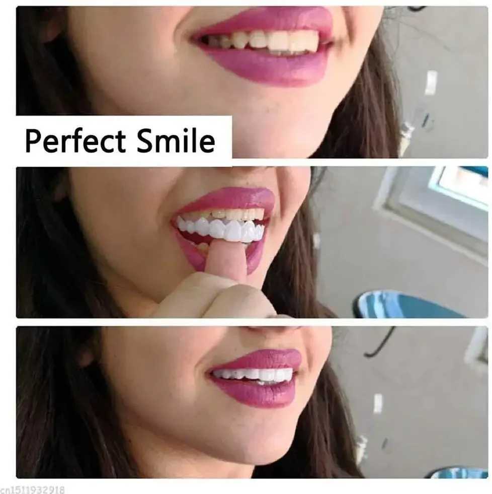 Sdatter 1 set of hot smile dentures cover denture veneer white bracket white teeth buckle cosmetic dental care M250410