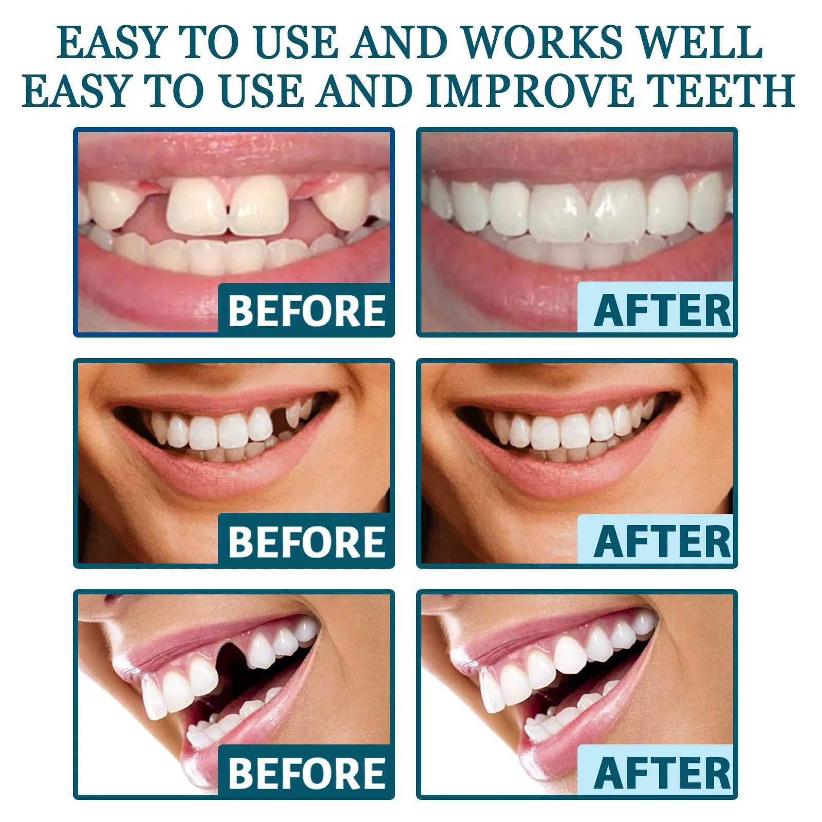 New Arrival Adjustable teeth set instant smile veneer teeth whitening natural portable bracket decorative gap between teeth Z250409