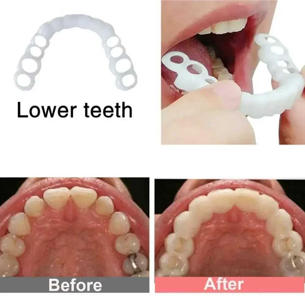 Sdatter 1 set of hot smile dentures cover denture veneer white bracket white teeth buckle cosmetic dental care M250410