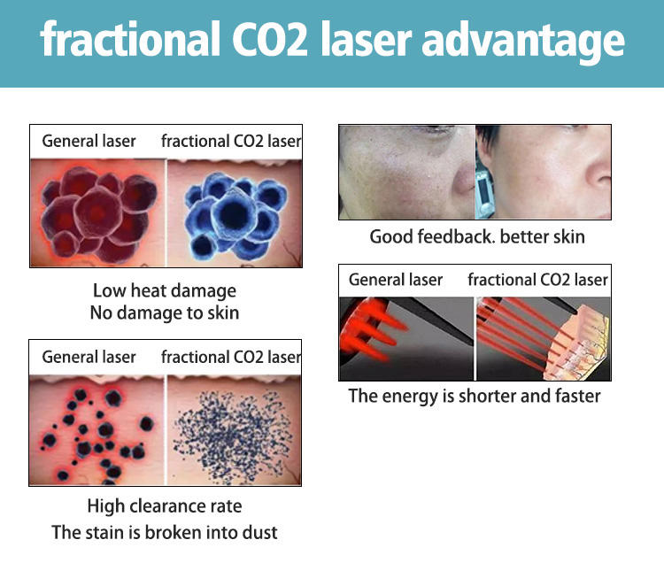 Fractional Co2 Laser Skin Rejuvenation Vaginal Tightening Acne Scar Removal Private Repair Stretch Mark Removal Anti-aging Lifting Scare Removal Skin 