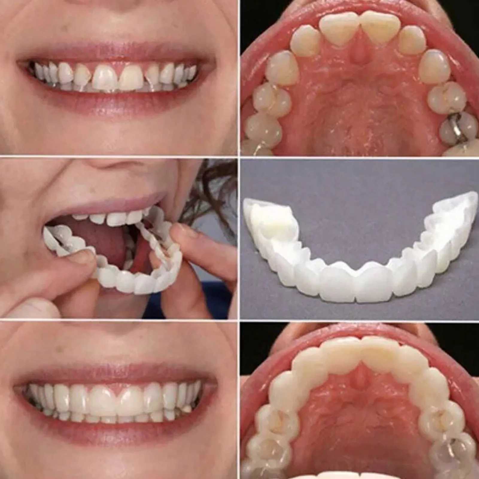 Hot selling veneers male and female dental sockets temporary upper and lower veneers for dental restoration M250410