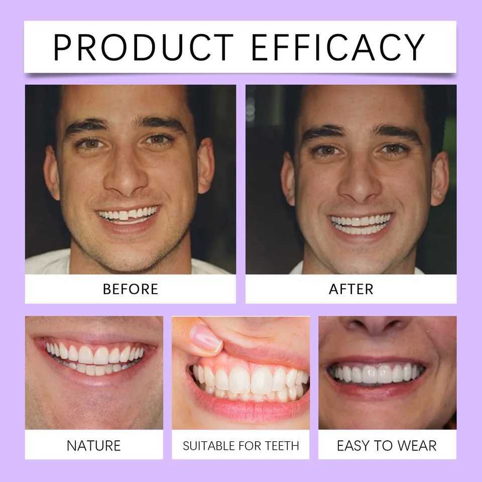 Oralhoe silicone resin braces filling brackets adjustable upper and lower veneers comfortable whitening dentures M250410