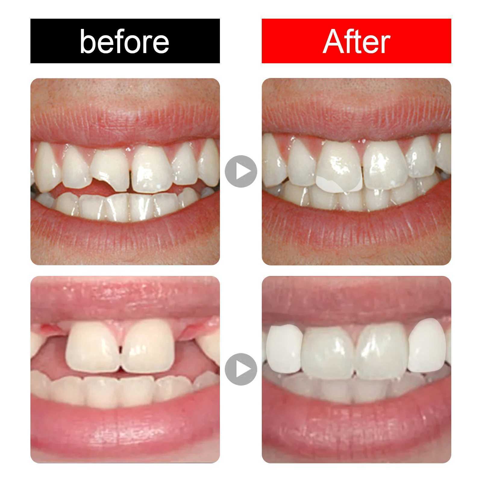 New Arrival Shape Gutta percha set easy to install durable does not fall off fills tooth gaps tooth bonding repair kit Z250410