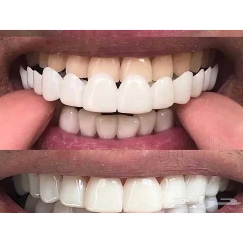 New Arrival SowSmile Silicone Smile Dental Hygiene Upper and Lower Dentures Cover Veneer Tooth Support Whitening Product Mold Z250410