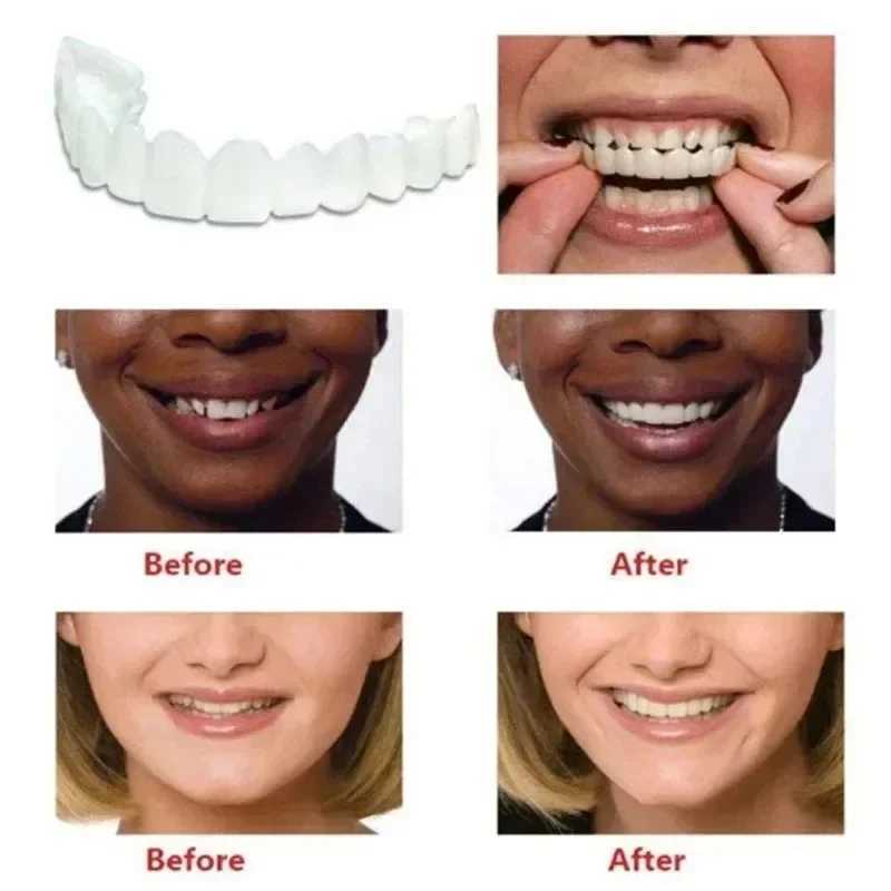 Perfect and bright veneers for upper and lower dentures comfortable fit and flexible teeth support for whitening M250409