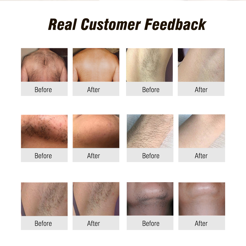 Winkonlaser 4 Wavelengths Laser Diode 808nm 755 940 1064NM Laser Beauty Equipment For Hair Removal