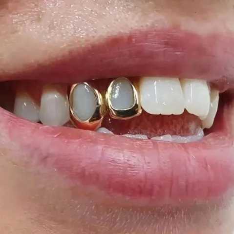 Hip Hop Hollow Double Teeth Grillz Punk 14K Gold Plated Hat Decorative Bracket Dental Grill W250412