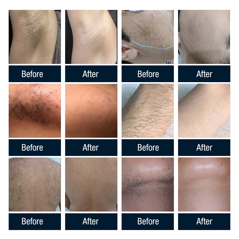 AresLite Diode Laser Hair Removal Machine USA stock with 4 Wavelength Skin Rejuvenation Bikini Hair Reduction Device