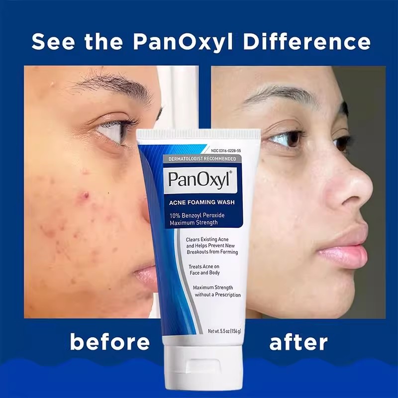 10% Benzoyl Peroxide Anti-Acne Face Wash - Moisturizing Deep Cleansing, Protecting Skin, Unclogging Pores, Oil Control on Face
