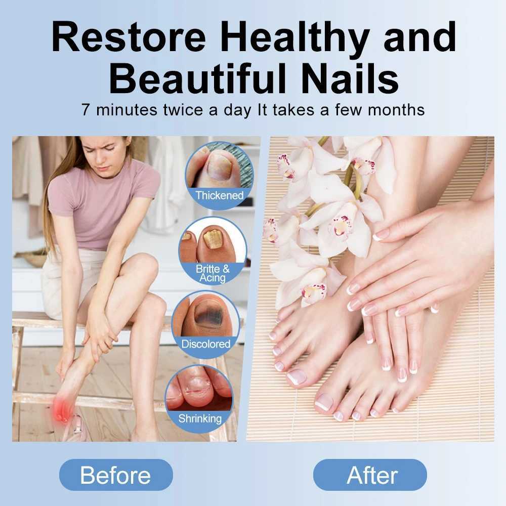 Nail fungus treatment UV LED lamp laser equipment for cleaning thyroiditis USB charging UV lamp for nail disinfection repair and care W250210