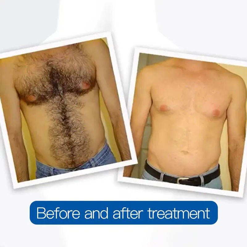 808nm Diode laser 3 Wavelength Laser Hair Removal Machine