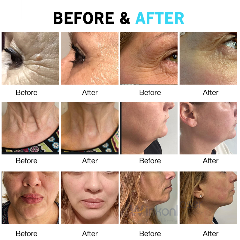 2025 Portable HIFU Smas Face Lifting Machine 13 Cartridges Vmax Wrinkle Remover Device for Anti-aging Body Shaping