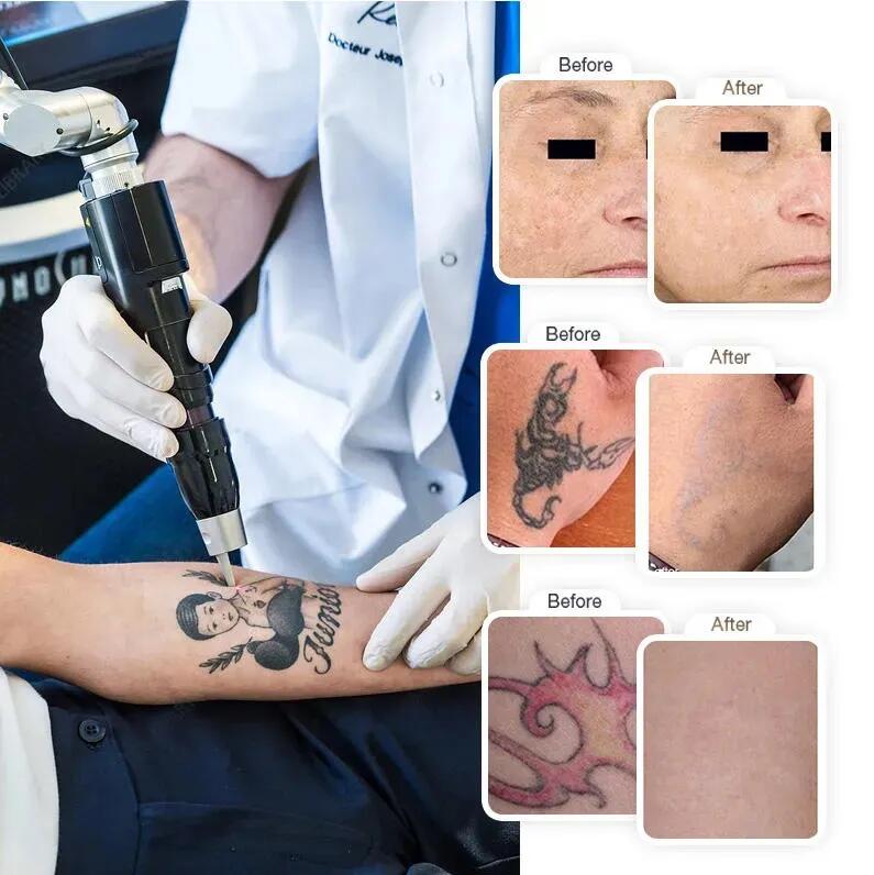 Newest Super Tattoo Removal Pico laser Acne Remove Freckle Removing Painless Tattoo Removal Pigmentation Treatment Pico Focus Spot Freckle Eliminate F