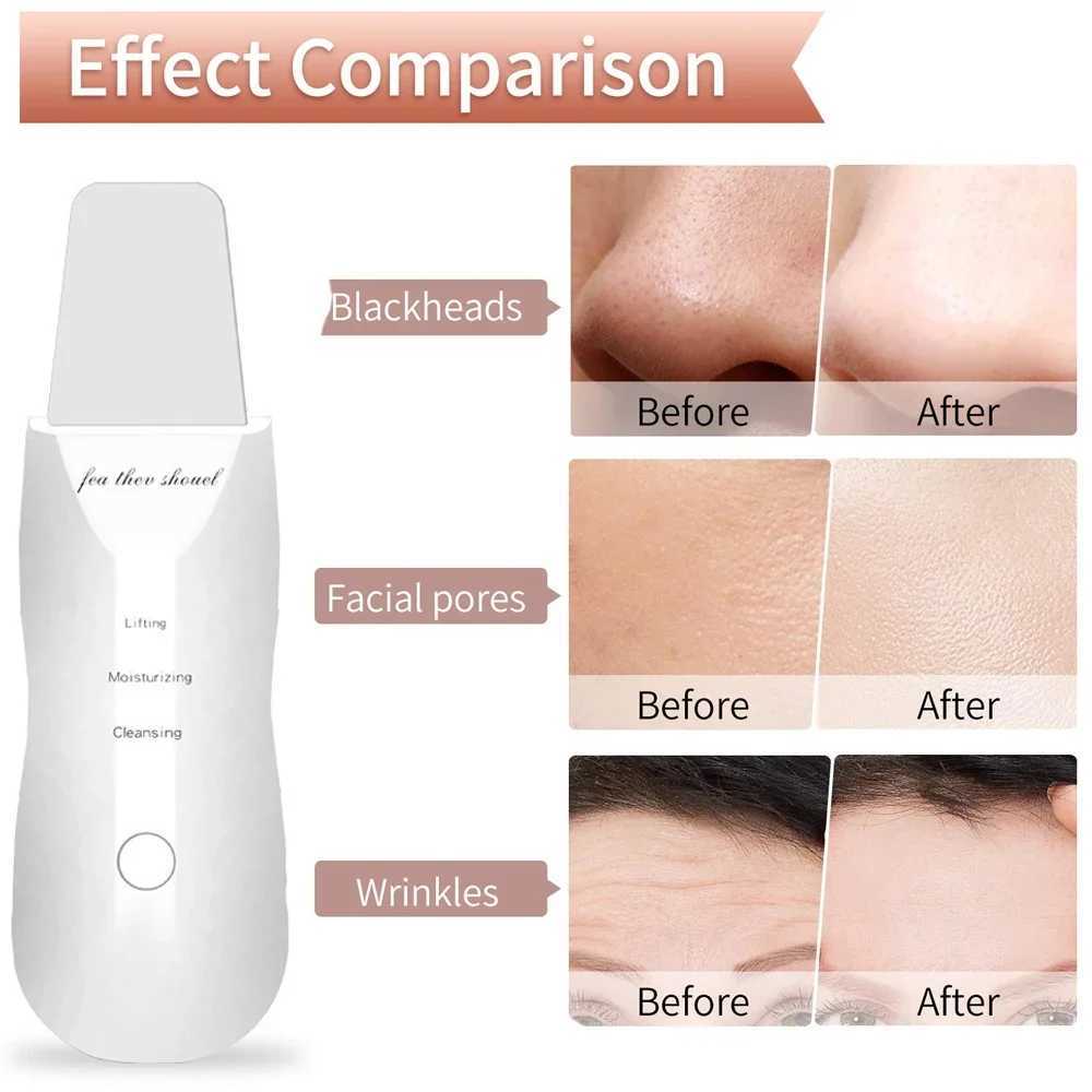 Electric Skin Scraper Peeling Blackhead Remover Ultrasonic Deep Face Cleaning Lifting Acne Pore Facial Spatula Shovel Cleanser XJ250607