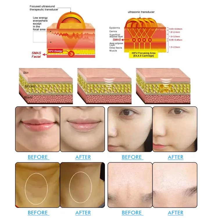 Portable 8D Hifu 9D 10D Machine Body Shape Wrinkle Removal Cartridge 1 Handle Hifu Facial 12D Anti wrinkle Machine Hifu Machine 9D