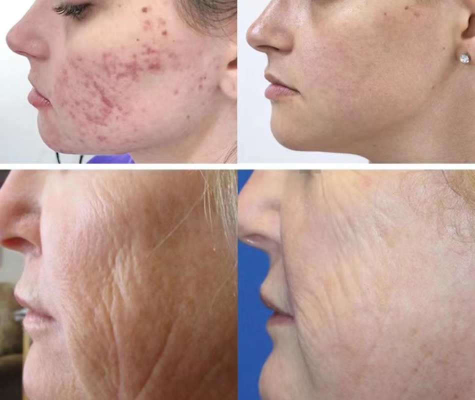 Gold Rf Microneedle Skin Rejuvenation Device, Rf Microneedling Machine Highly Effective Anti-Aging Skin Tightening, Beauty Salon Acne and Scar Removal