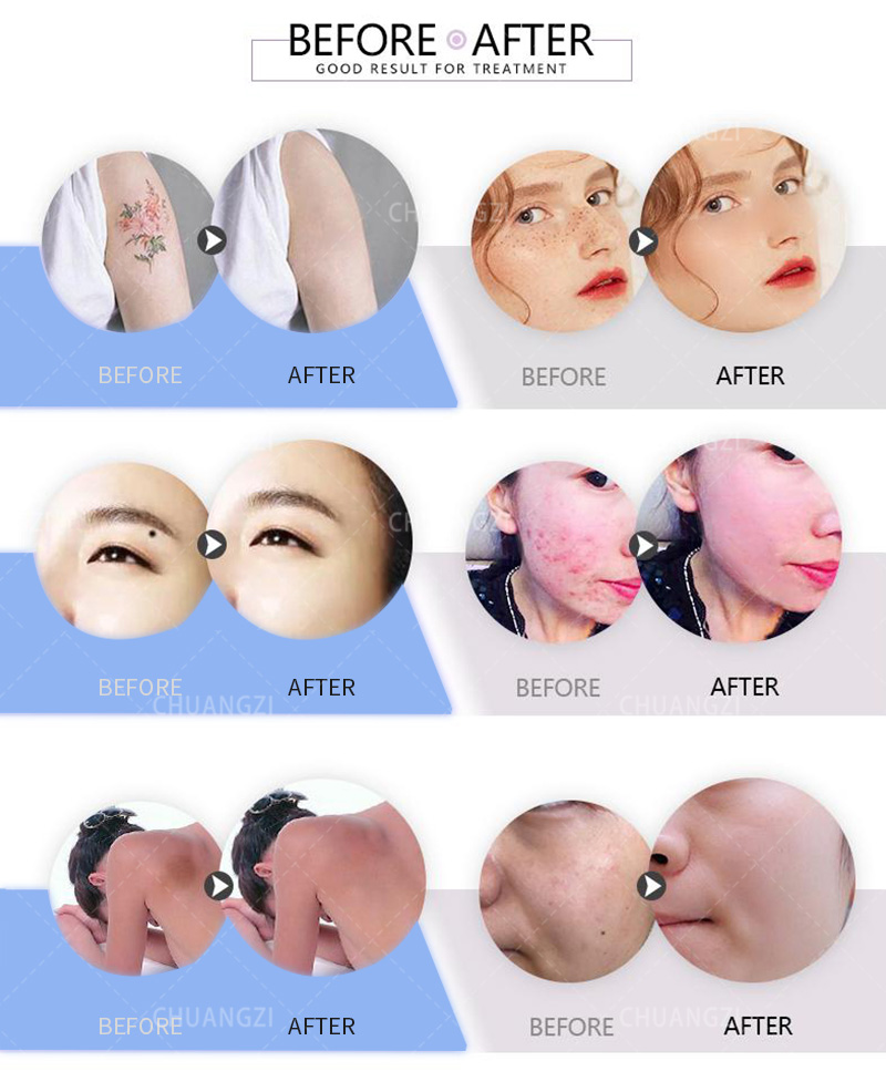 Portable Laser Tattoo Removal Machine Diode Technology Quickly Removes Pigments Suitable For a Variety Of Skin Colors