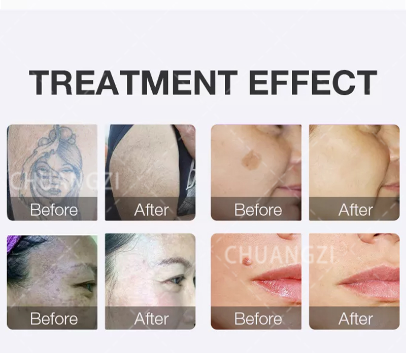 HOT Picosecond Q Switched 532nm755nm 1064nm 1320 nmNd Yag Laser Tattoo Removal Machine Pico Laser Beauty Equipment