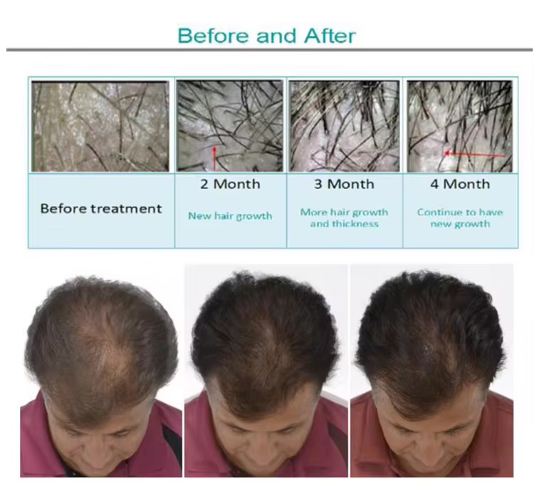 650nm Growth Laser Diode Hair Growth Machine Laser Regrowth High Frequency Electrotherapy Ozone Comb Hair Loss Treatment