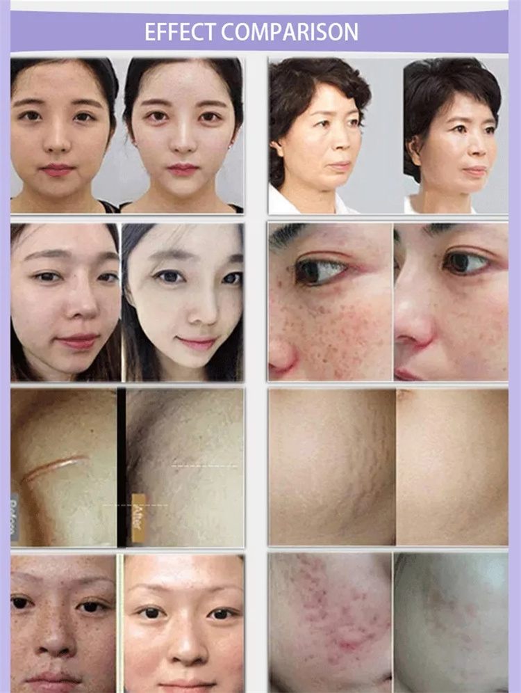 Gold RF Micro-needle Beauty Instrument High Frequency Anti-aging, Firming and Wrinkle Removal Pore Lifting Beauty Salon Special Equipment