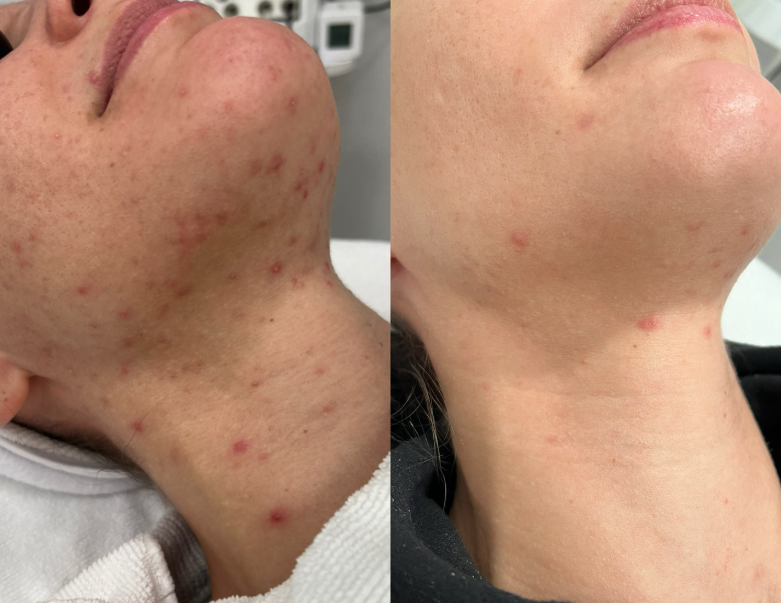 Beauty Salon Aesthetic Equipment Multifunctional 9 In 1 Fibroblast Cold Ozone Plasma Pen Machine High Frequency Spark Plasma For Acne Treatment Face R