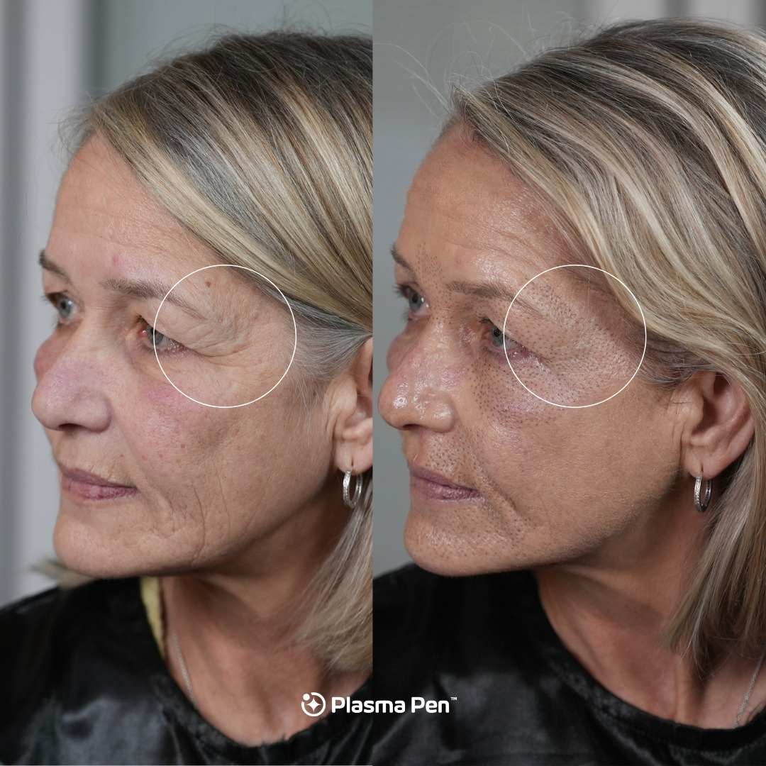 Beauty Salon Aesthetic Equipment Multifunctional 9 In 1 Fibroblast Cold Ozone Plasma Pen Machine High Frequency Spark Plasma For Acne Treatment Face R