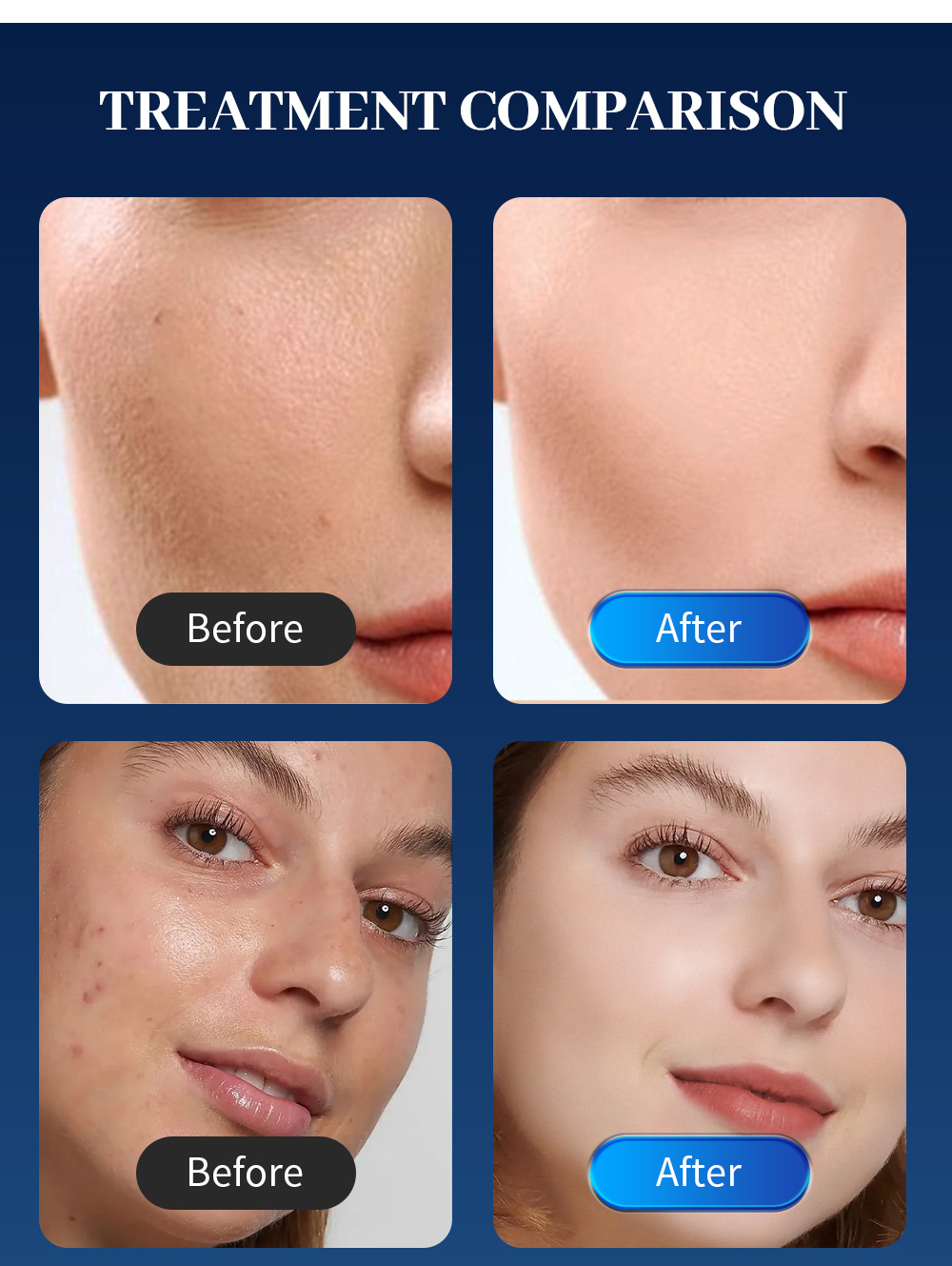 HOT Rf Equipment Radio Frequency Skin Lifting Acne Scar Treatment Fractional Rf Micro-needling Machine Beauty Salon Exclusive