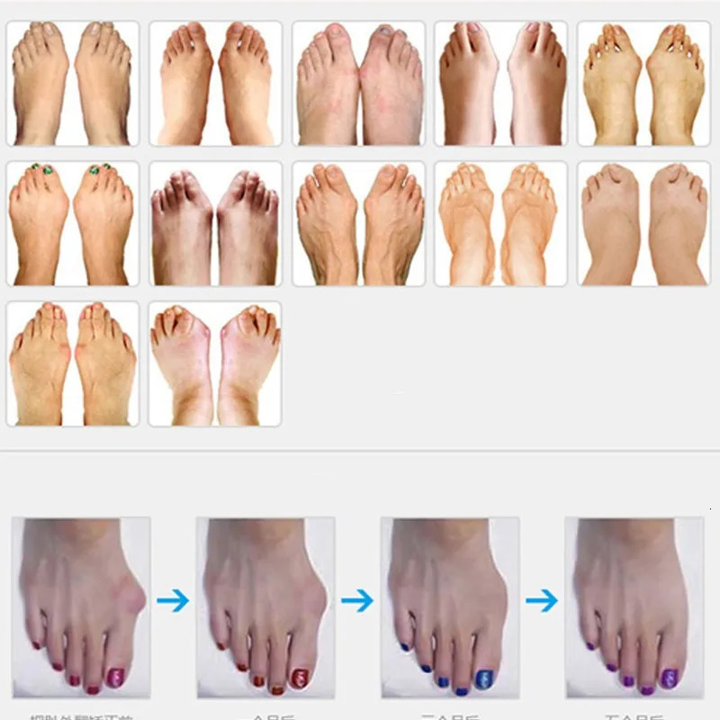 2pcs=1pair Hallux Valgus Silicone Corrector Gel Foot Care Toe Separator Little Finger Protector Bunion Straightener Pedicure 250613