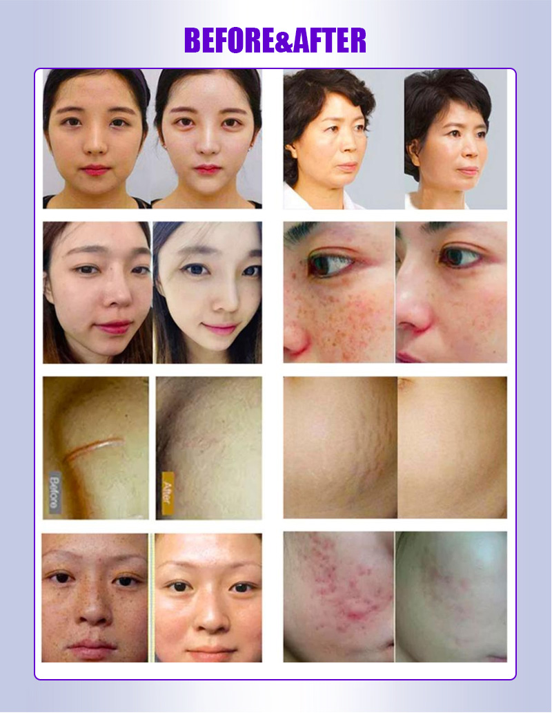 Flying Shuttle Plastic Thermal Dot Matrix Facial Contour System Repairs Acne Pits and Marks Lightens Fine Lines Beauty Instrume