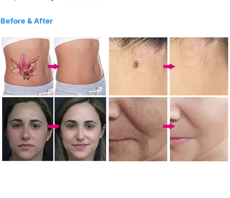Wholesale Price 5 Heads Pico Second Lasersings Tattoo Removal Machine Picosecond Lasersings with Non-invasive Heads