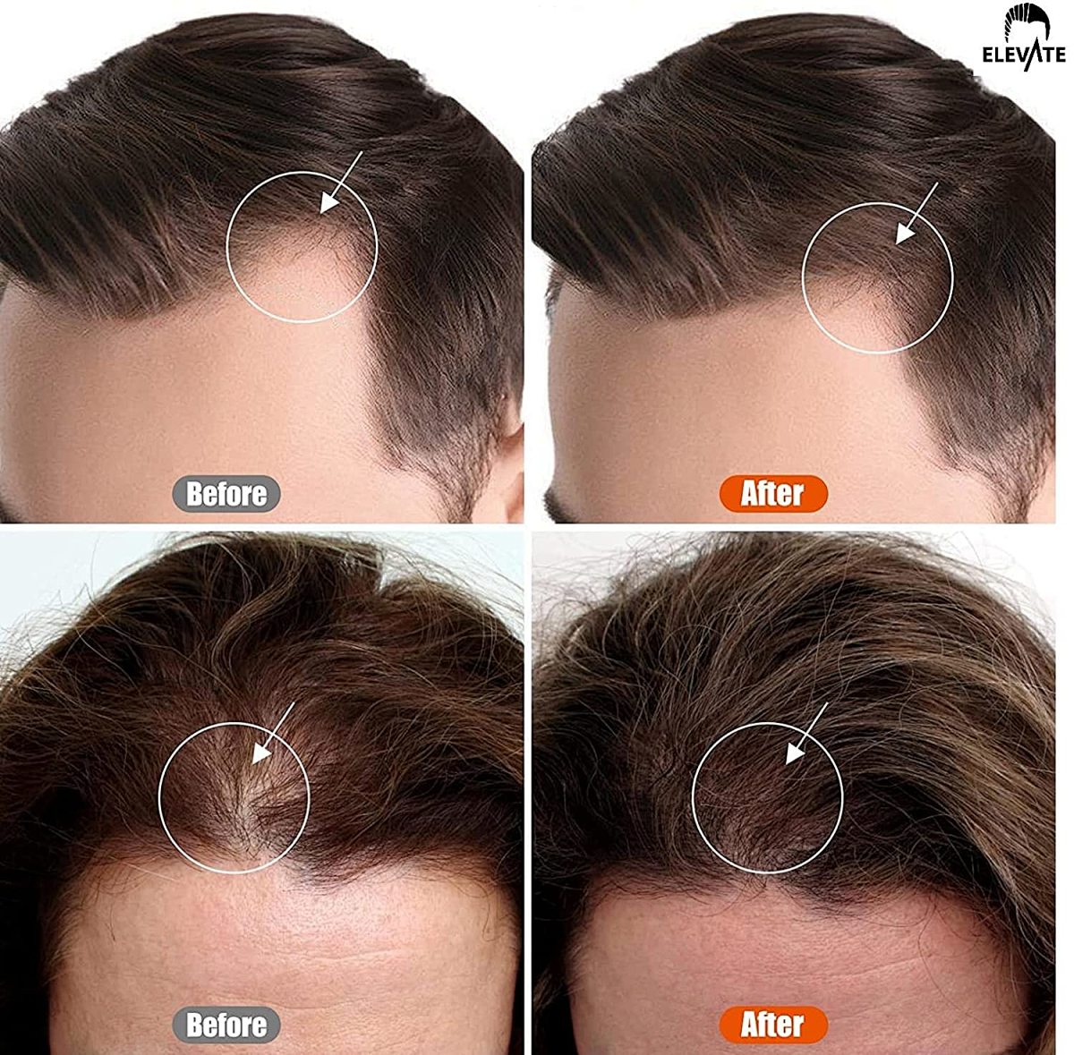 100 Titanium Microneedle Derma Stamp with Adjustable Length - At-Home Derma Roller for Beard & Skin Care