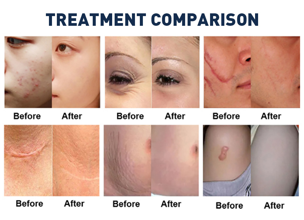High Precision 10600nm Fractional CO2 Laser Equipment for Scar Repair, Collagen Boosting and Skin Firming Treatment