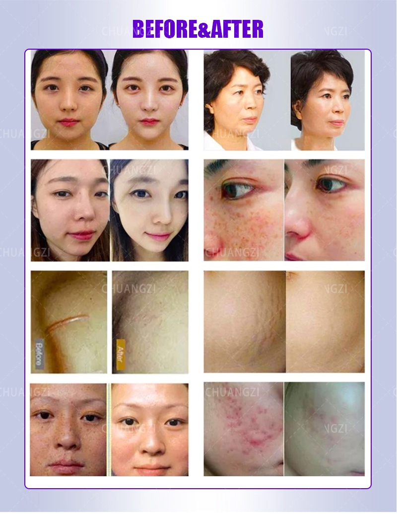 Microneedle Rf Beauty Device Firming, Lightening Fine Lines, Improving Enlarged Pores, Brightening Skin Tone, Skin Rejuvenation Device