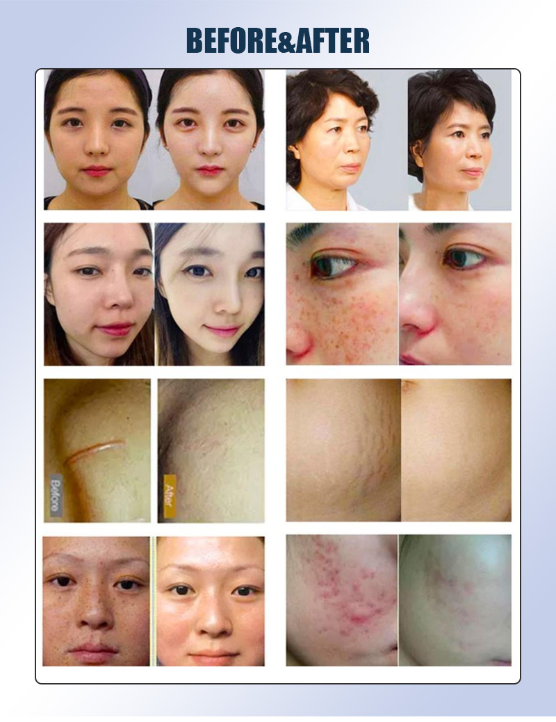 Gold Rf Microneedle Machine For Facial Anti-Aging, Firming, Pore Removal, Acne Scar Removal, Wrinkle Removal, Professional Beauty Salon Equipment