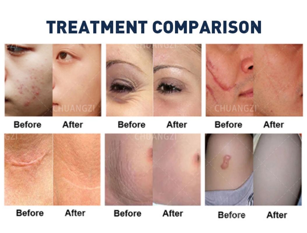 CO2 Laser Machine for Skin Carbon Peel Professional Fractional Laser Machine Portable Skin Firm Beauty Salon Exclusive