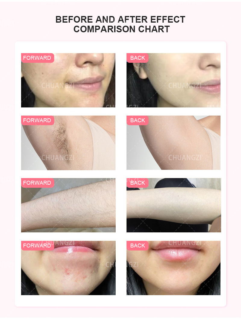 OPT 3 Wavelength Portable Hair Removal Laser Machine Professional Equipment For Painless Hair Removal and Skin Rejuvenation NEW