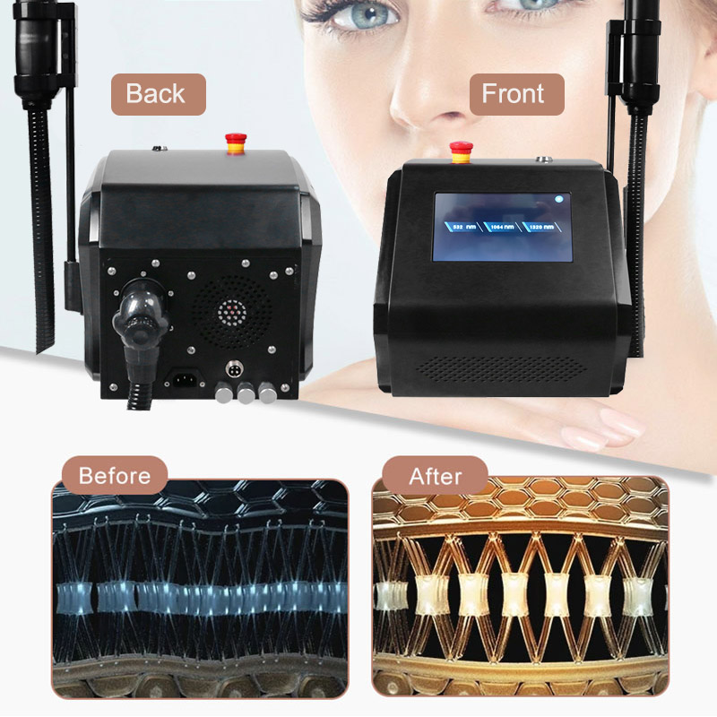Portable Picolaser Nd Yag Pico Second Picosecond Laser Remove Freckles Q Switched Laser For Tatoo Removal Black Doll Treatment Skin Rejuvenation Machi