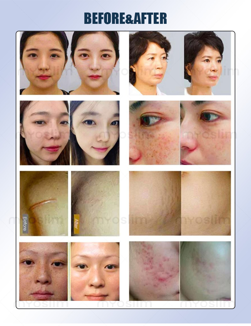 Rf Microneedle Machine, Firming and Lifting, Deep Repair, Professional Skin Rejuvenation and Wrinkle Removal Equipment, Beauty Salon Recommendation