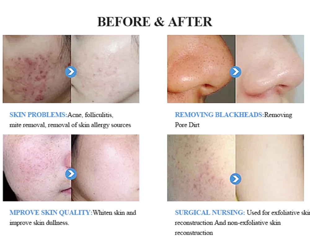 Professional Hydra Dermabrasion facial Skin Care Machine Remove Blackhead Facial Cleaning Rejuvenation