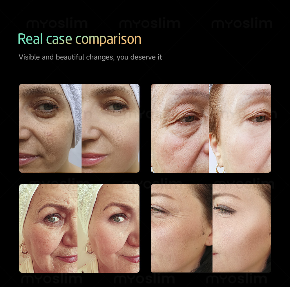 High Intensity 360MAX 25D Hifu+RF+EMS Home Use Hifu Beauty Machine Focused Ultrasound Skin Firming Face Lifting Hifu