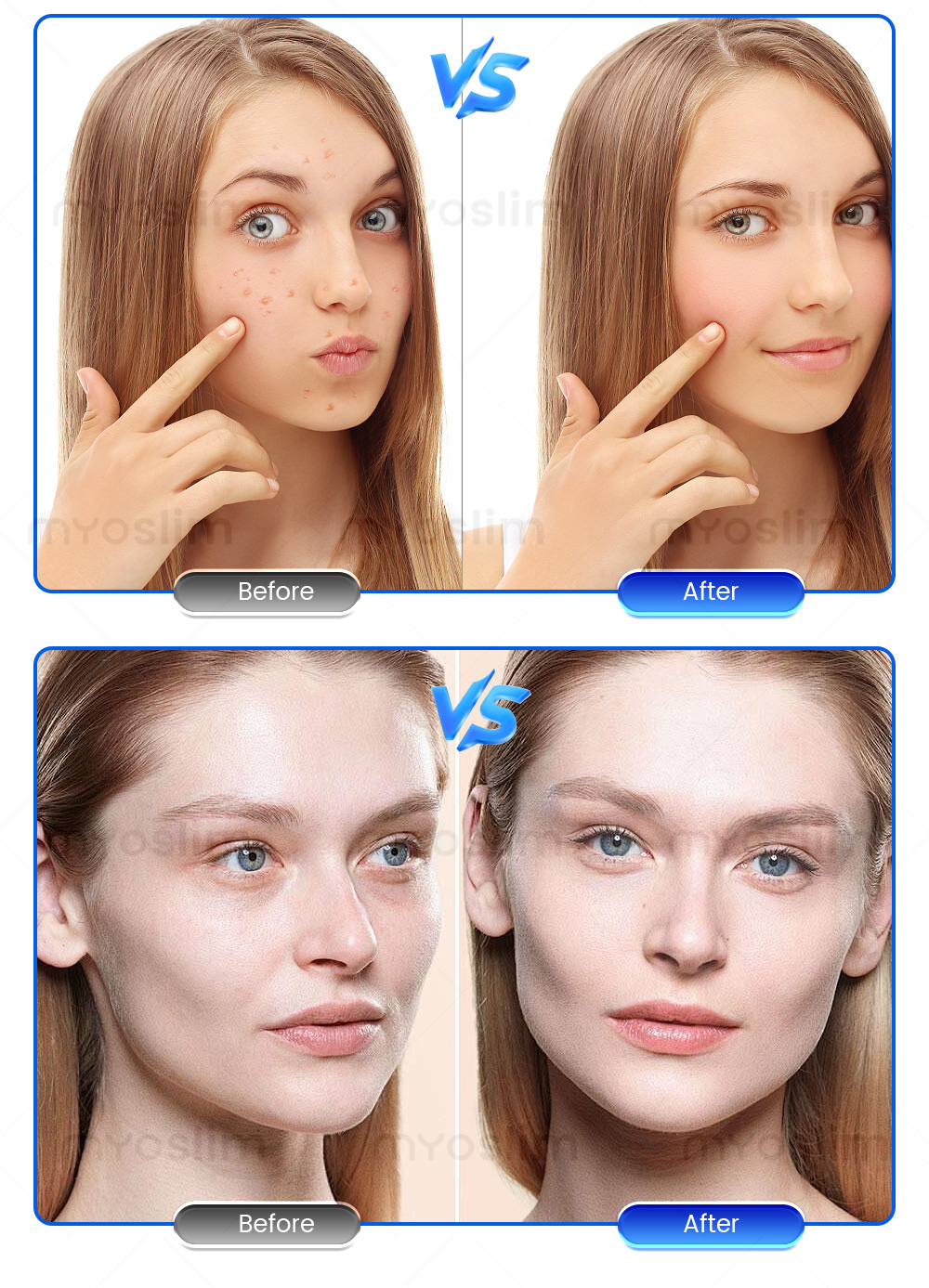 Rf Microneedle Acne Scar Removal Device Is a Highly Effective Anti-Aging and Skin Tightening Beauty Device, a Must-Have For Professional Skin Care HOT