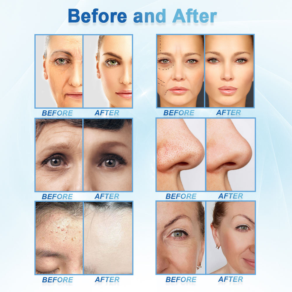 New 11 in 1 Microdermabrasion Facial Deep Cleansing Water Aqua Peeling Hydra Dermabrasion Machine Skin Scalp Analyzer Facial Cleansing Hydro Skin Anal